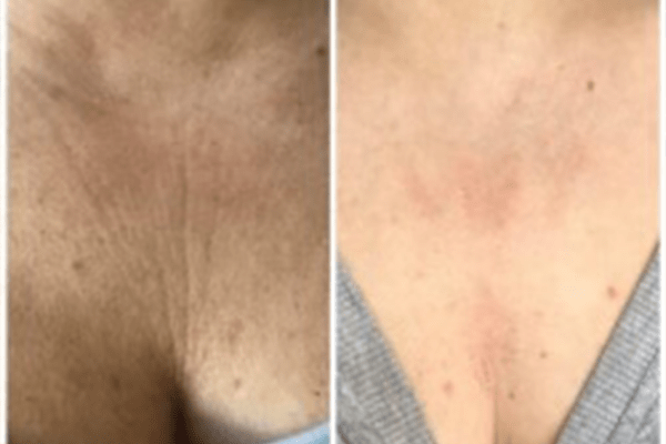 Skin Tightening