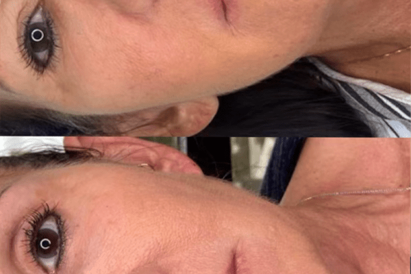 Skin Tightening