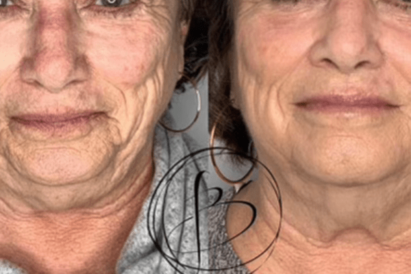 Skin Tightening