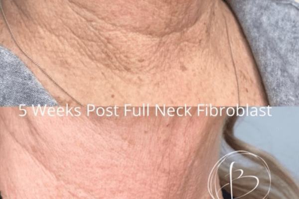 Skin Tightening
