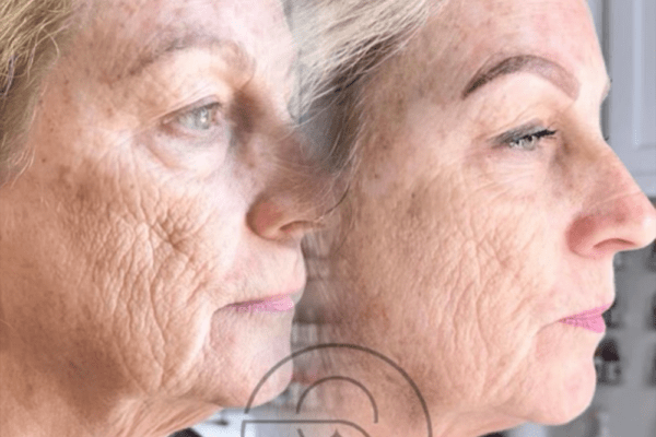 Skin Tightening