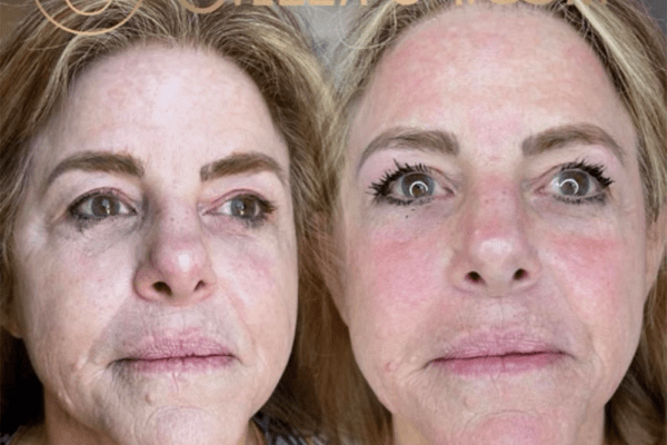 Skin Tightening