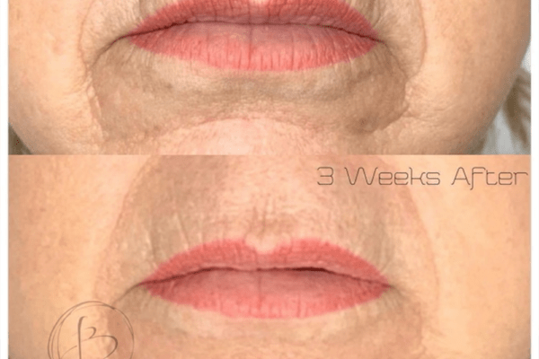 Skin Tightening
