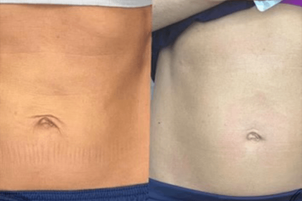 Skin Tightening