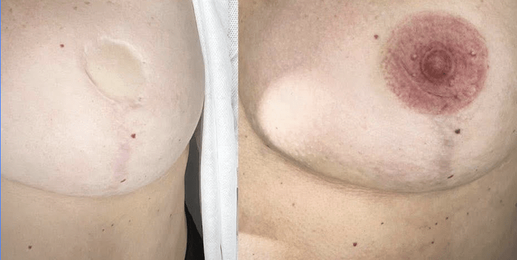 Areola restoration