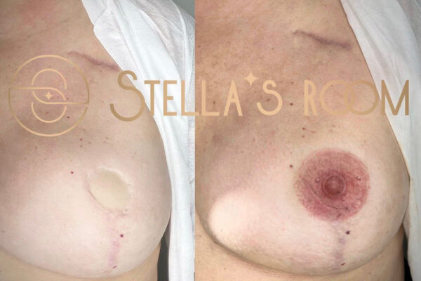 Areola restoration
