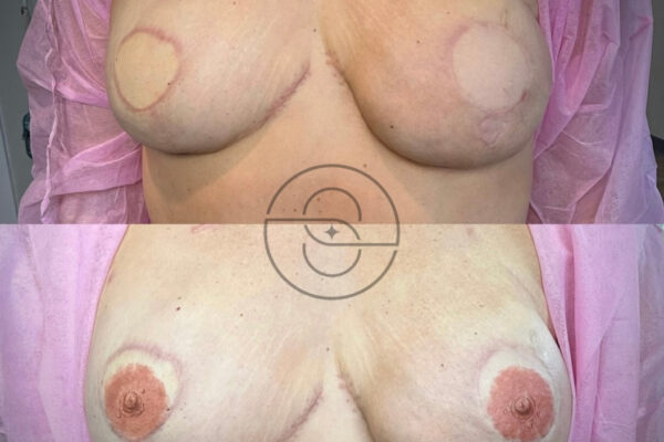 Areola restoration