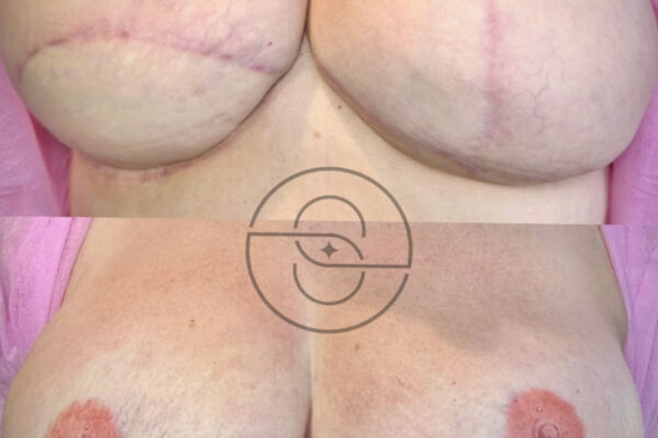 Areola restoration